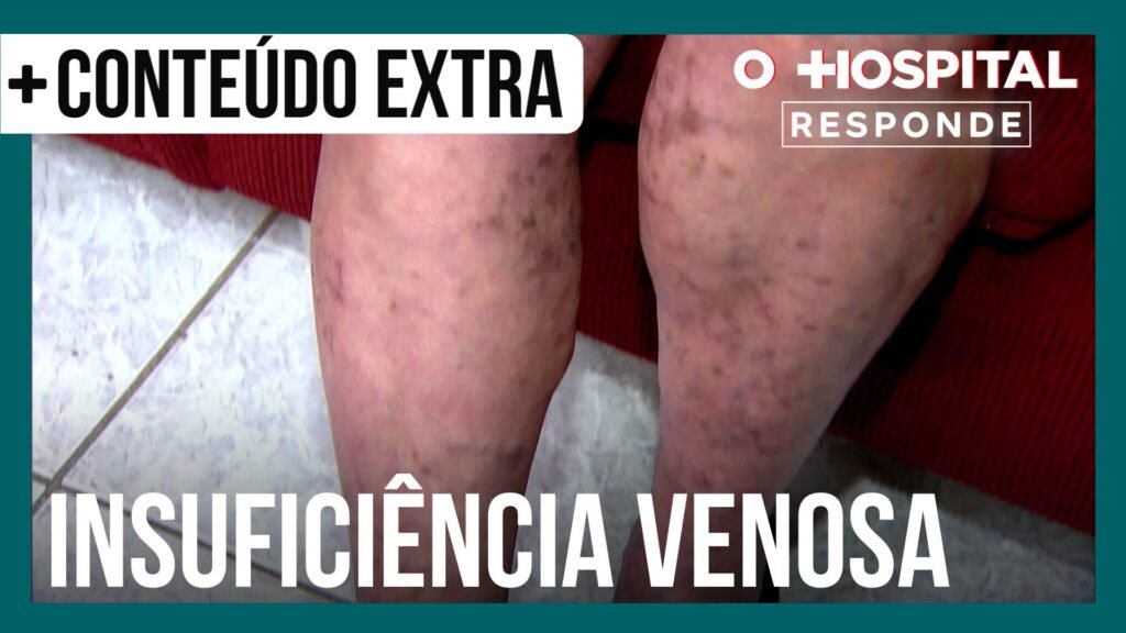 cirurgio-vascular-explica-quais-so-as-causas-da-insuficincia-venosa-|-o-hospital-responde